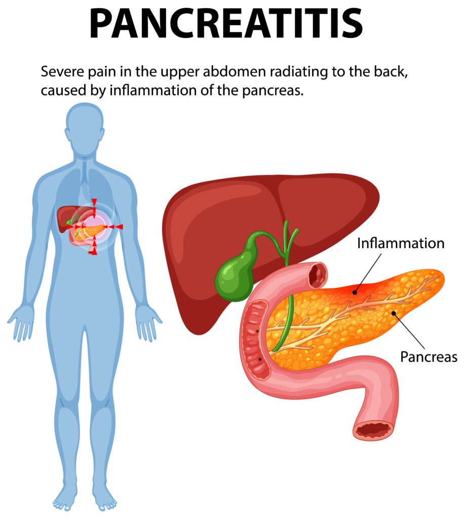 Understanding Pancreatitis and Its Symptoms